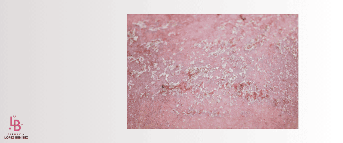 Controla la Dermatitis Seborreica y Recupera la Salud de tu Cuero Cabelludo